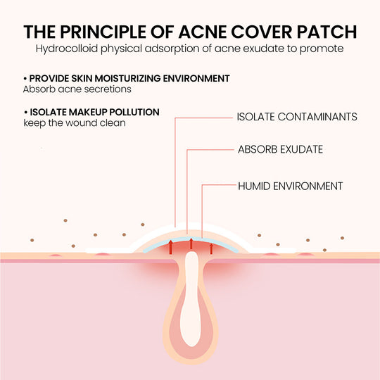 Pimple Patches,Pimple Patches For Face, Hydrocolloid Acne Patches, Cute Star Stickers Hydrocolloid Acne Pimple Patch For Covering Zits And Blemishes
